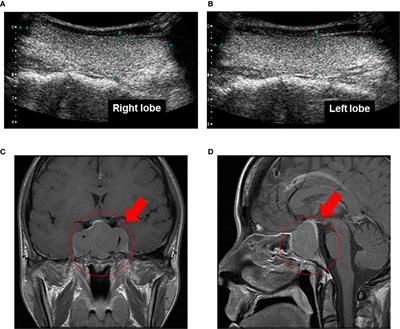 Case Report: A Case of Pituitary Adenoma Producing Growth Hormone and Thyroid-Stimulating Hormone Simultaneously